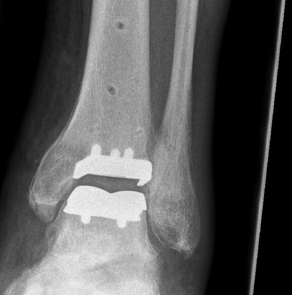 Röntgenbild mit implantiertem Kunstgelenk