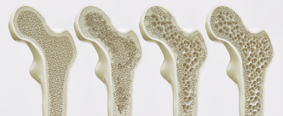 Knochendichtemessung: Osteoporose Stufen