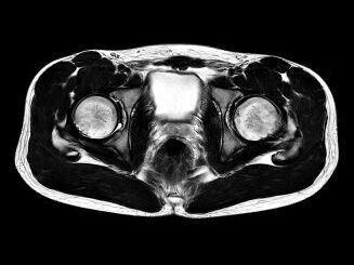 MRT Aufnahme Becken - transversal