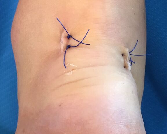 Kleine Hautschnitte nach Entfernung der Haglund-Exostose in minimal-invasiver Technik Kleine Hautschnitte nach Entfernung der Haglund-Exostose in minimal-invasiver Technik