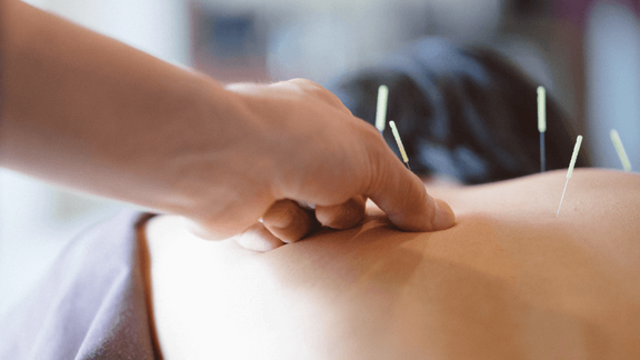 Bild einer Akupunktur-Behandlung