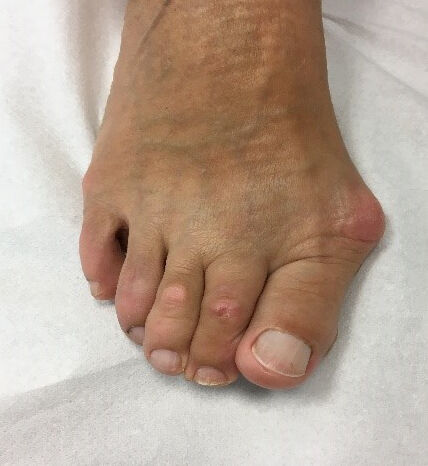 Hallux Valgus