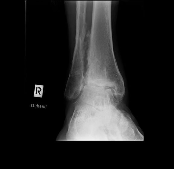 Arthrose des oberen Sprunggelenkes im Röntgenbild Arthrose des oberen Sprunggelenkes im Röntgenbild