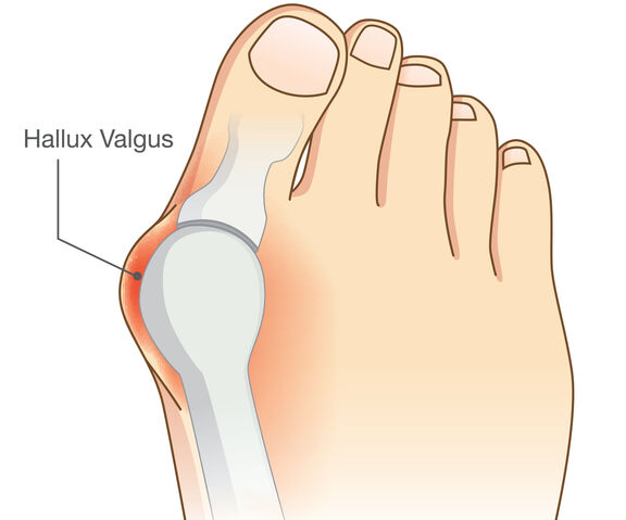 Hallux Valgus Hallux Valgus