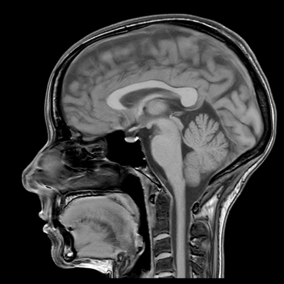 MRT Aufnahme Kopf - sagittal