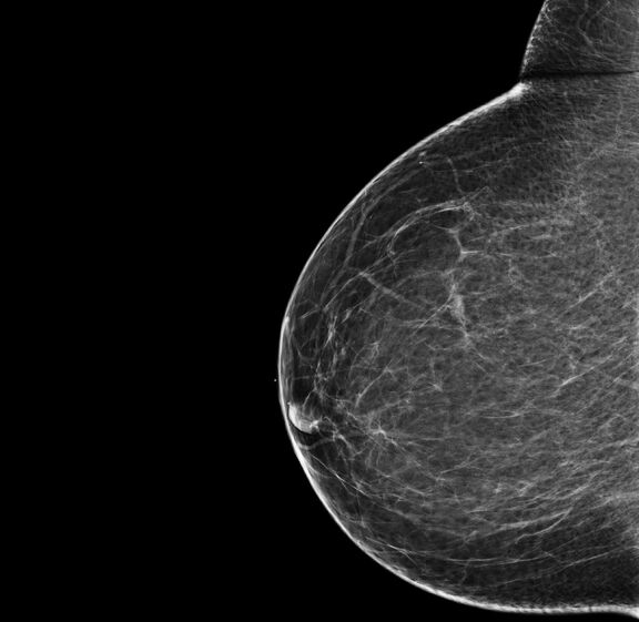 Das Bild zeigt eine 3D-Mammographie-Aufnahme.