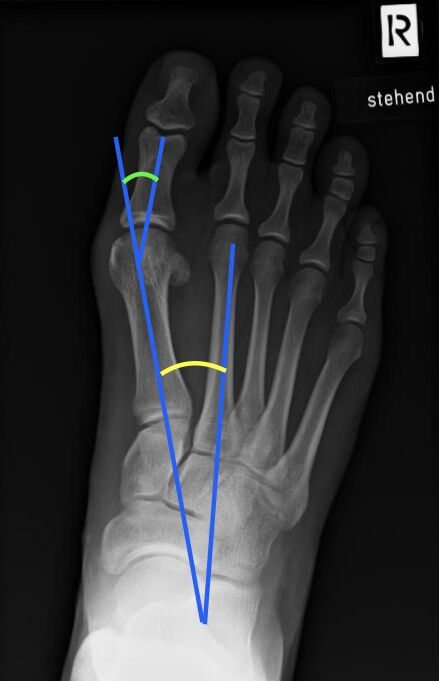 Röntgenbild mit eingezeichneten Winkeln zur Bestimmung des Schweregrades