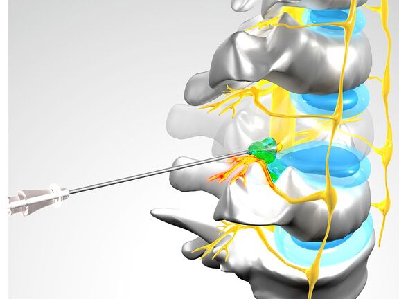 Schematische Darstellung einer PRT Schematische Darstellung einer PRT