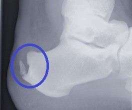 Röntgenbild mit Haglundexostose und dorsalem Fersensporn