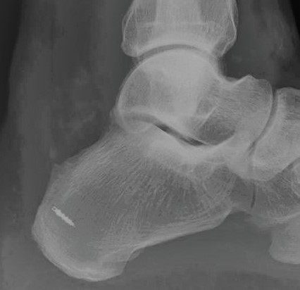 Röntgenbild nach Entfernung der Haglund-Exostose und des dorsalen Fersenspornes mit Einbringen eines Knochenankers