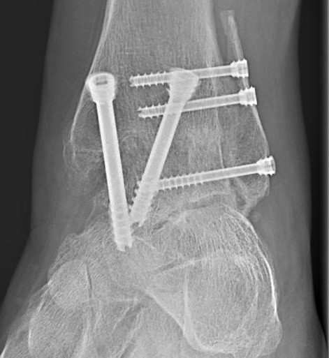 Röntgenbild nach Versteifung des oberen Sprunggelenkes
