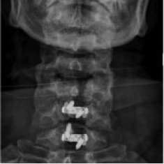 erstes Bild eines Bandscheibenvorfalls in der Halswirbelsäule (postoperativ)