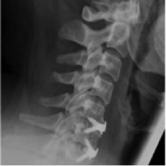 zweites Bild eines Bandscheibenvorfalls in der Halswirbelsäule (postoperativ)