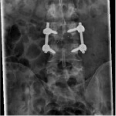 zweites Bild einer Spondylodiszitis (postoperativ)