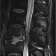 erstes Bild einer Spondylodiszitis (präoperativ)