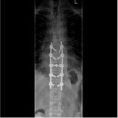 zweites Bild mit Tumor an der Wirbelsäule (postoperativ)