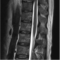 zweites Bild mit Tumor an der Wirbelsäule (präoperativ)