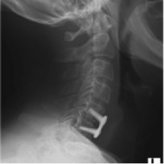 erstes Bild einer Spinalkanalstenose (postoperativ)