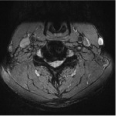 erstes Bild einer Spinalkanalstenose (präoperativ)