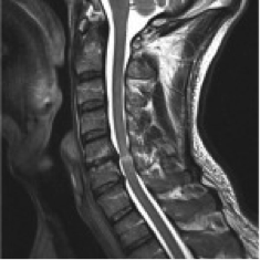 zweites Bild einer Spinalkanalstenose (präoperativ)