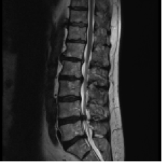 drittes Bild einer Spinalkanalstenose (präoperativ)