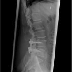 erstes Bild einer Spondylolisthese (postoperativ)