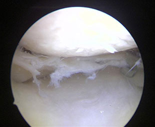 Degenerativer Meniskusriss