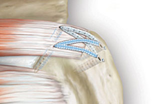 Einbringen eines 4. Ankers und Fixierung der überkreuzten Fäden zur optimalen Stabilisierung der Rotatorenmanschette am Oberarmknochen
