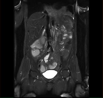 MRT-Abdomen Aufnahmen - Koronar