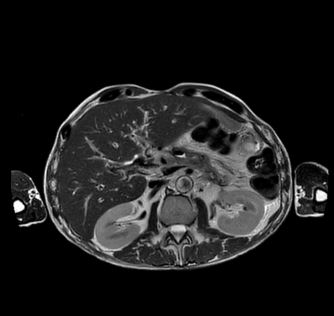 MRT-Abdomen Aufnahmen - Transversal