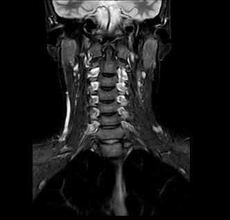 MRT Aufnahme Hals - koronar