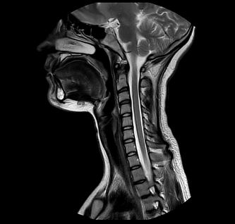 MRT Aufnahme Hals - sagittal
