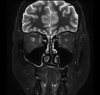 Aufnahme MRT Nasennebenhöhlen (NNH) - koronar