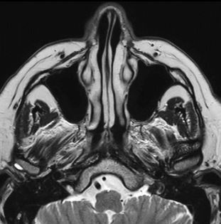 Aufnahme MRT Nasennebenhöhlen - transversal