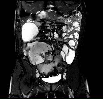 MRT Aufnahme Sellink - koronar