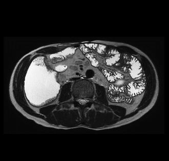 MRT Aufnahme nach Sellink - transversal