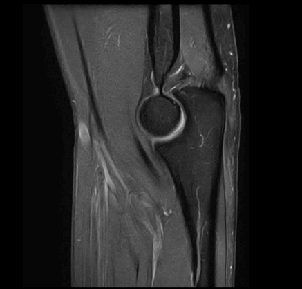 MRT Aufnahme Ellenbogen - sagittal