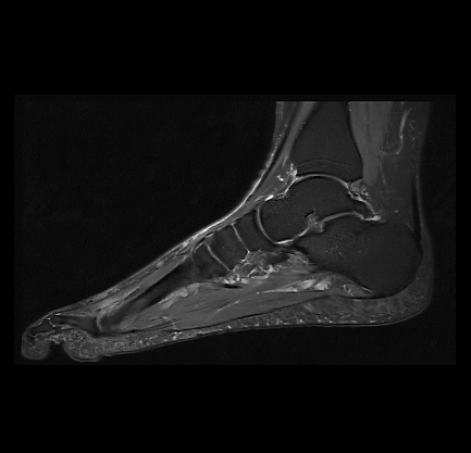 MRT Aufnahme Fuß - sagittal