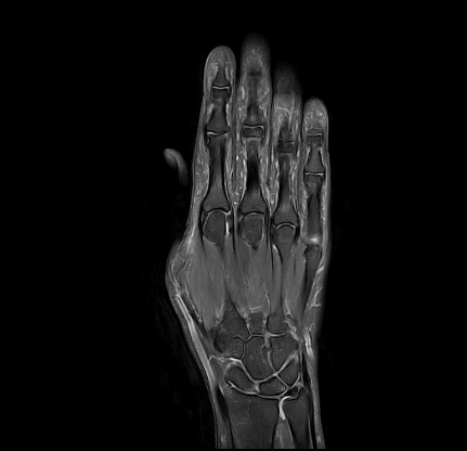 MRT Aufnahme Hand - koronar
