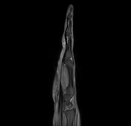 MRT Aufnahme Hand - sagittal