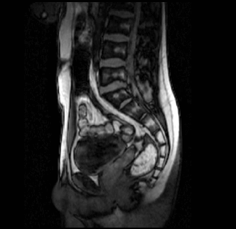MRT Aufnahme ISG - sagittal