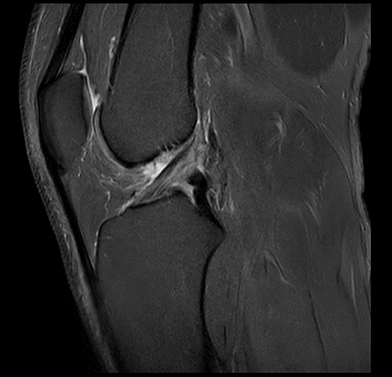MRT Aufnahme Knie - sagittal