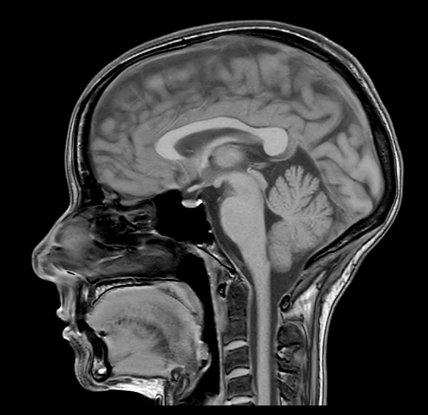 MRT Aufnahme Kopf - sagittal