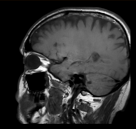 MRT Aufnahme Augenhöhle (Orbita) - sagittal