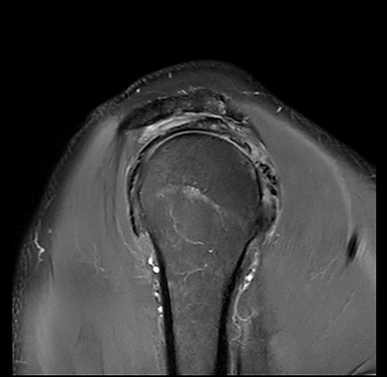 MRT Aufnahme Schulter - sagittal