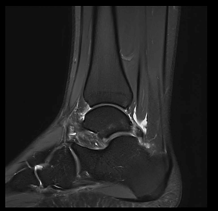 MRT Aufnahme OSG - sagittal